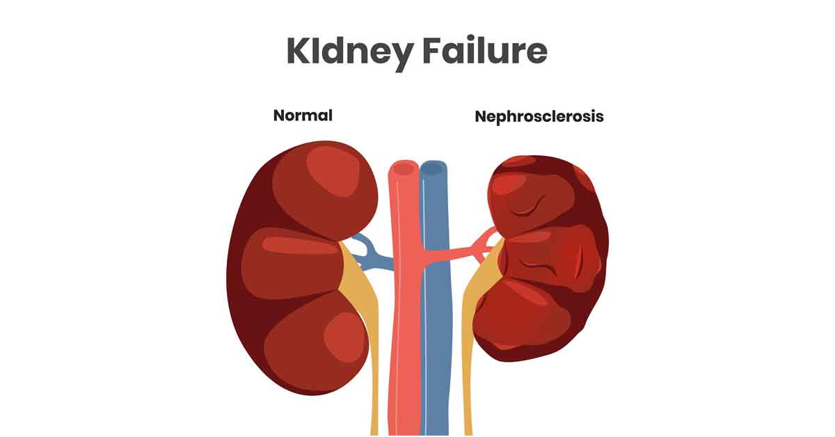 Chronic Kidney Disease and Kidney Damage Symptoms You Shouldn’t Ignore