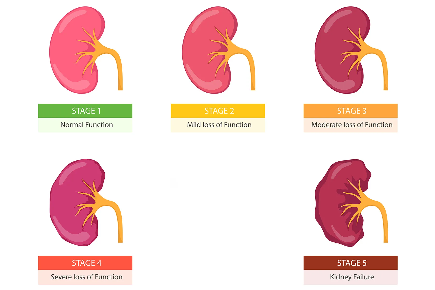 Chronic Kidney Disease and Kidney Damage Symptoms You Shouldn’t Ignore