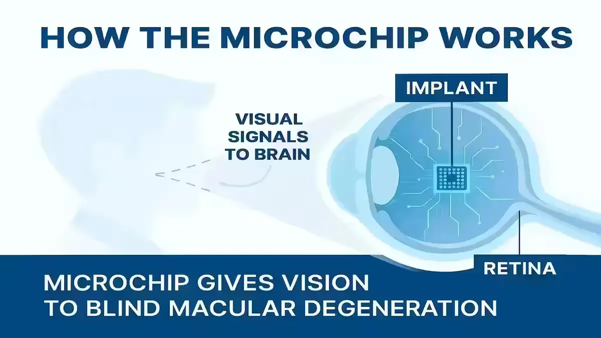 Microchip Restores Vision in Age-Related Macular Degeneration Patients microchip implant restoring vision in macular degeneration patients